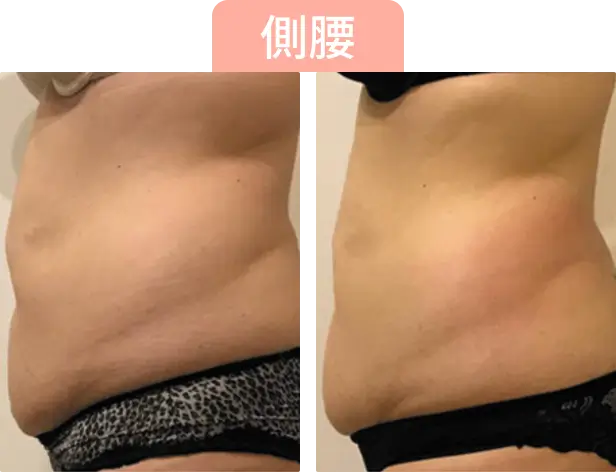左側是改變前的側腰，右側是改變後的側腰，展示Onda Pro治療後效果不同的身形效果。