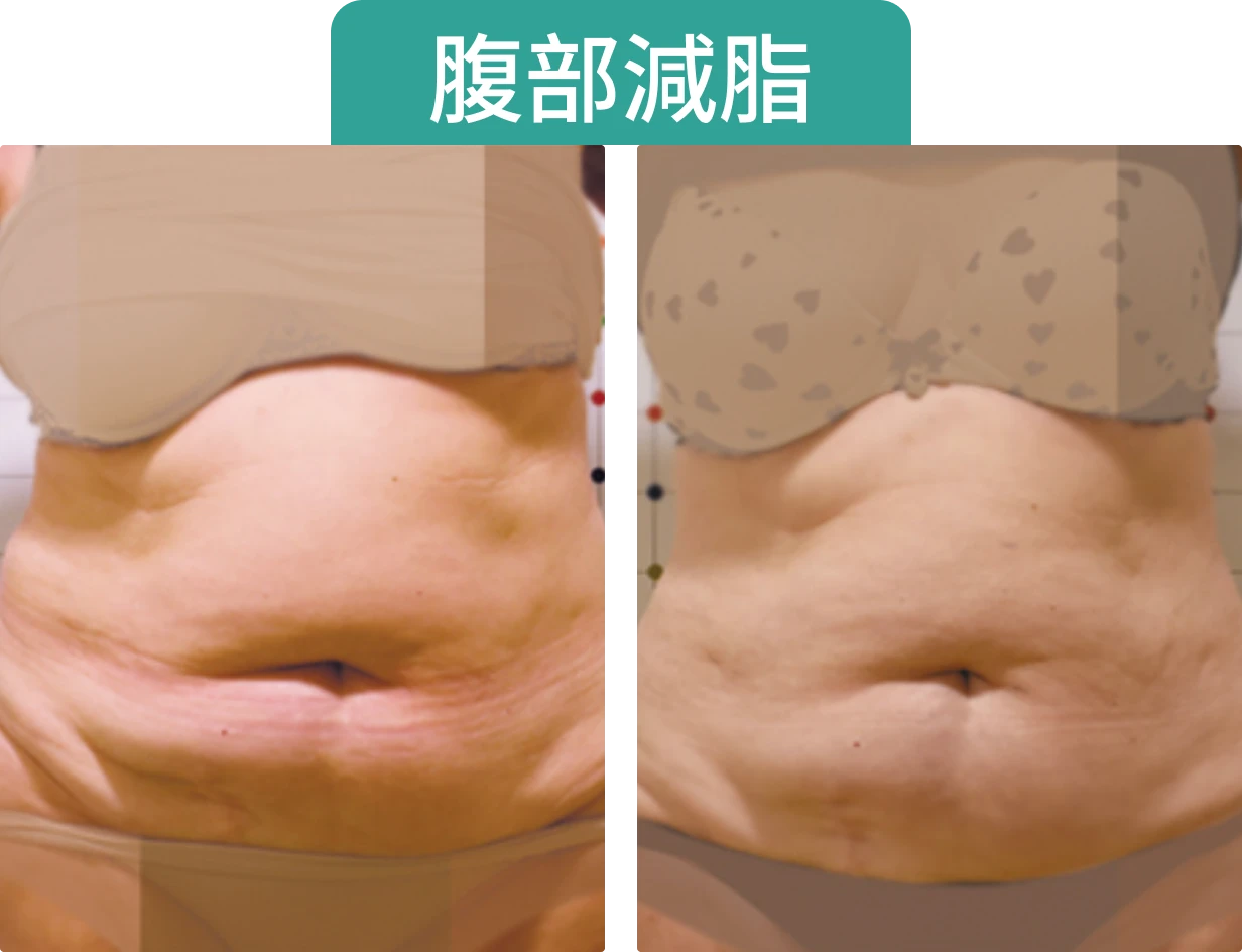 腹部減脂前後對比圖片，顯示減脂後的腹部輪廓變化。