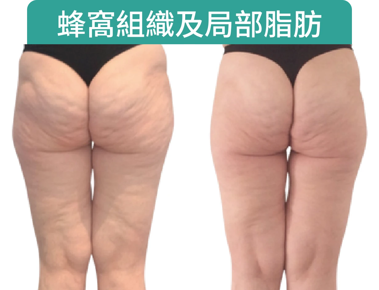 展示兩個人的臀部，左側有明顯的脂肪和紋路，右側則較為平滑。