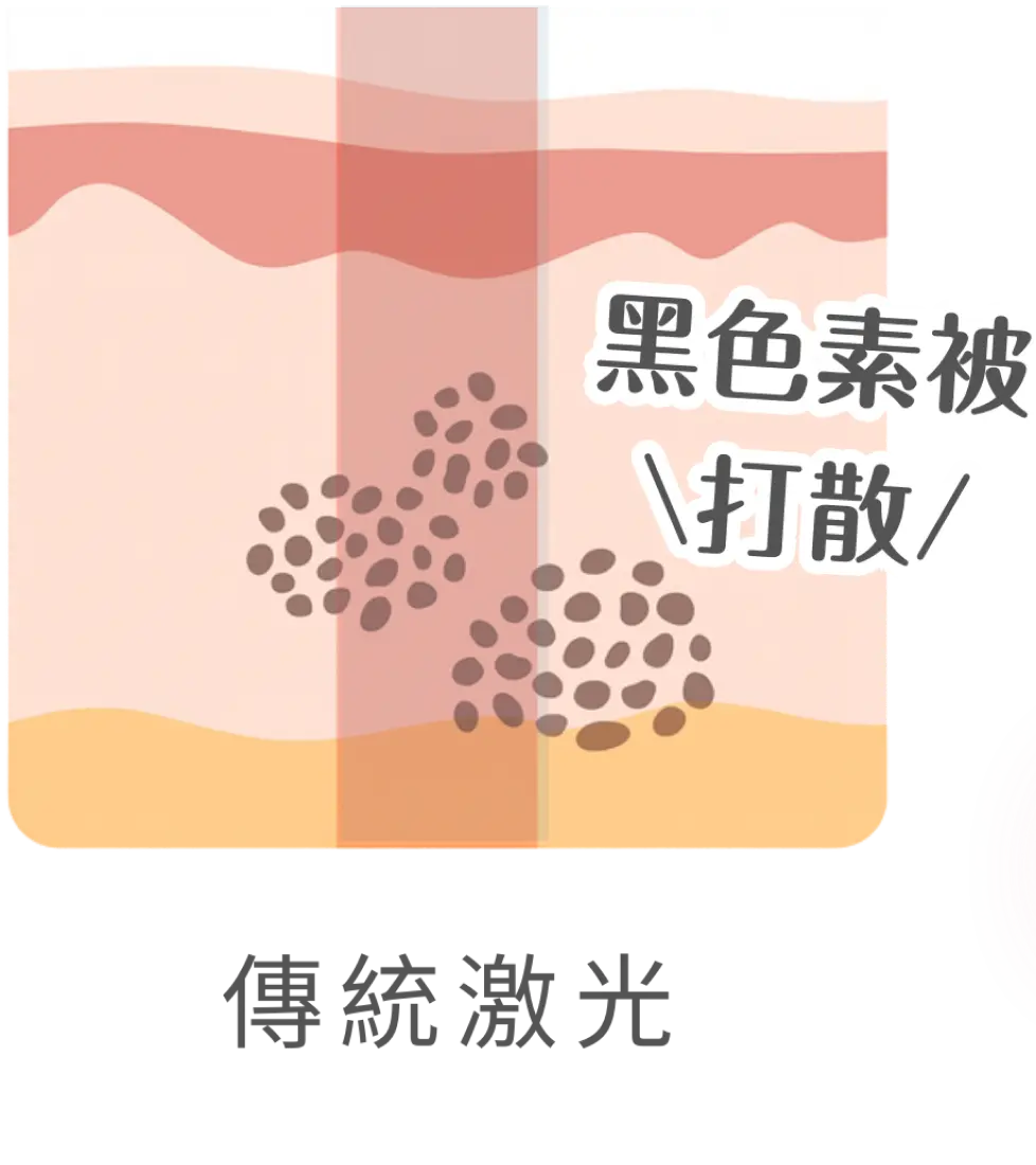 顯示傳統激光僅能打散黑色素示意圖