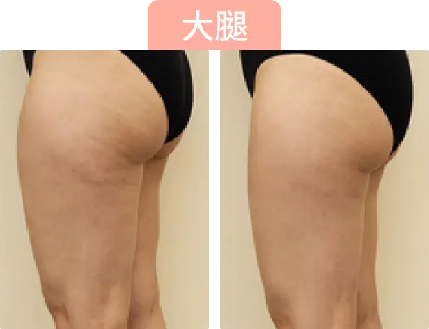 圖片展示了兩條大腿的側面，左側有條紋，右側較為平滑。上方有「大腿」字樣。