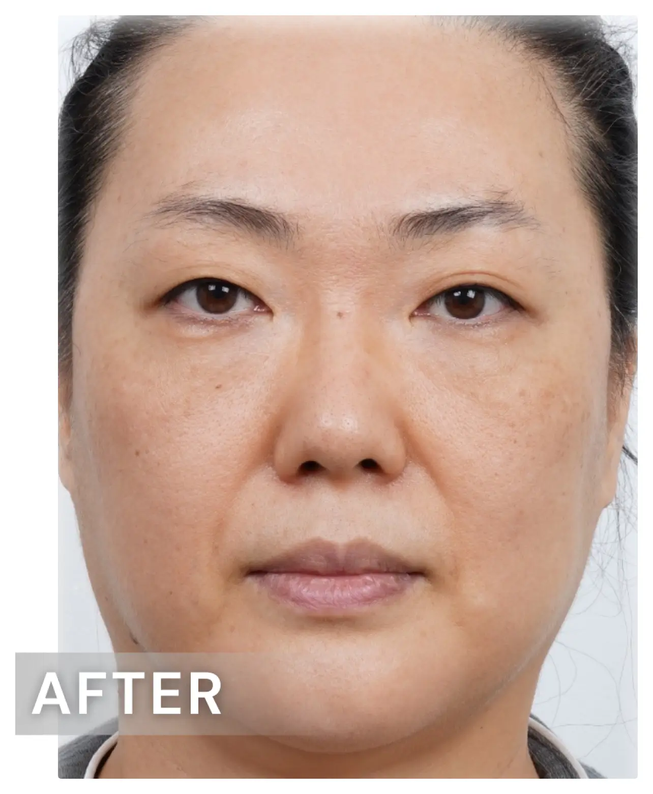 面部皺紋-after.webp