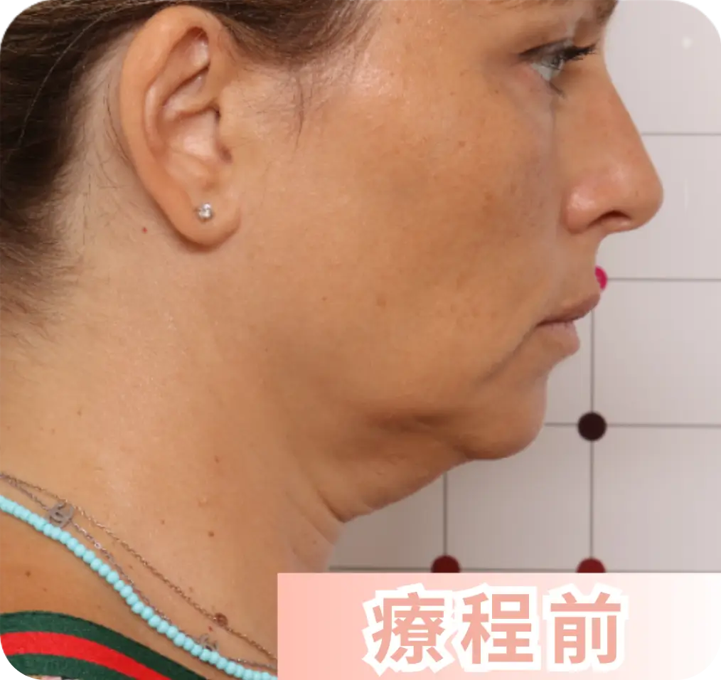 療程前.webp