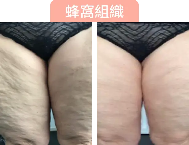 圖片顯示兩條大腿的比較，左側有明顯的妊娠紋，右側較光滑，標題為「蜂窩組織」。