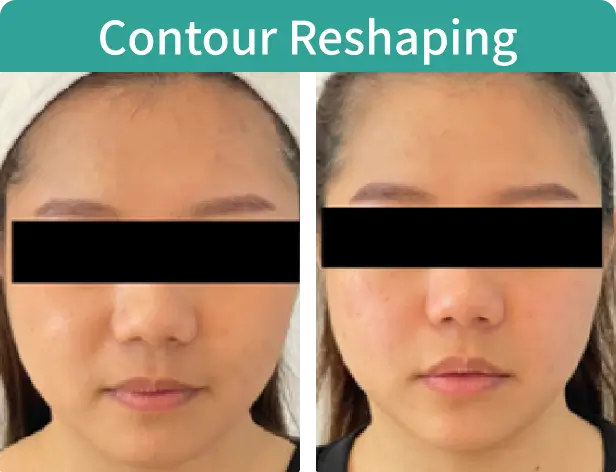 Contour Reshaping-4.webp
