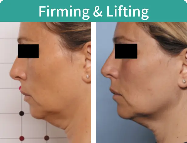 Firming & Lifting-2.webp