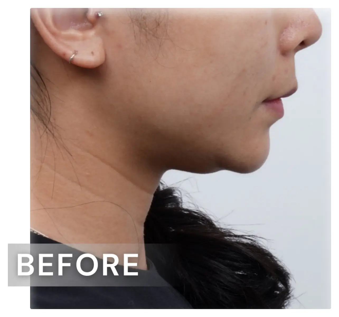 雙下巴1-before.webp
