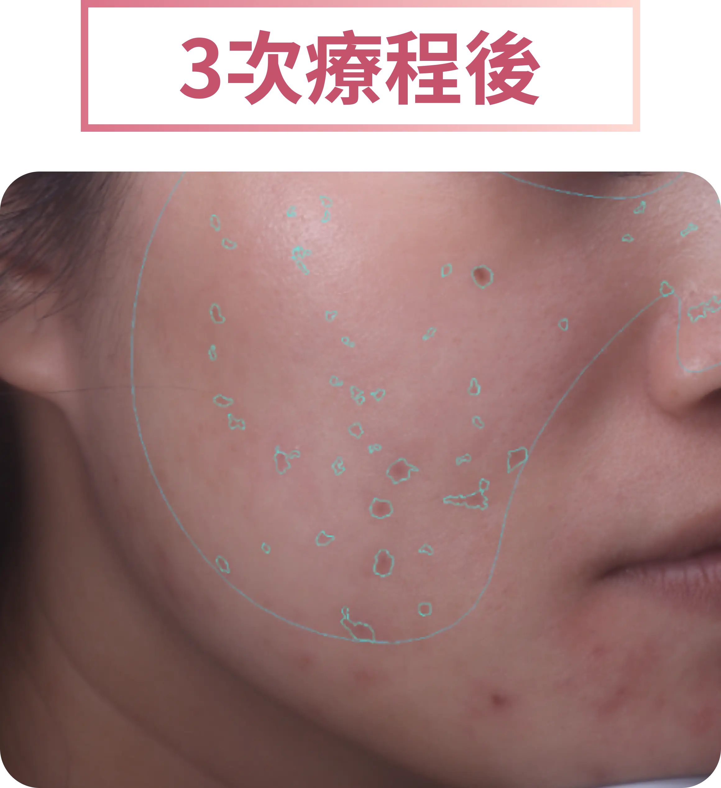 3次療程後（皮秒治療：面頰色斑與痘印改善示意）