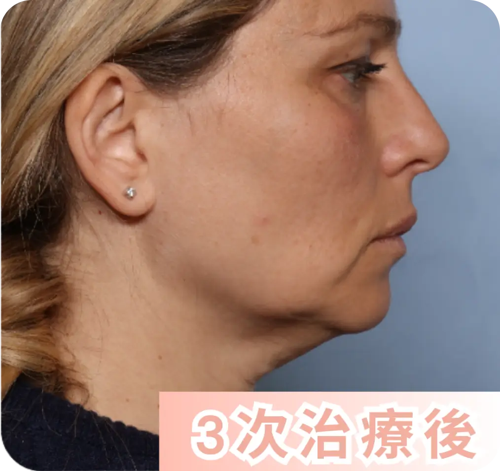 3次治療後.webp