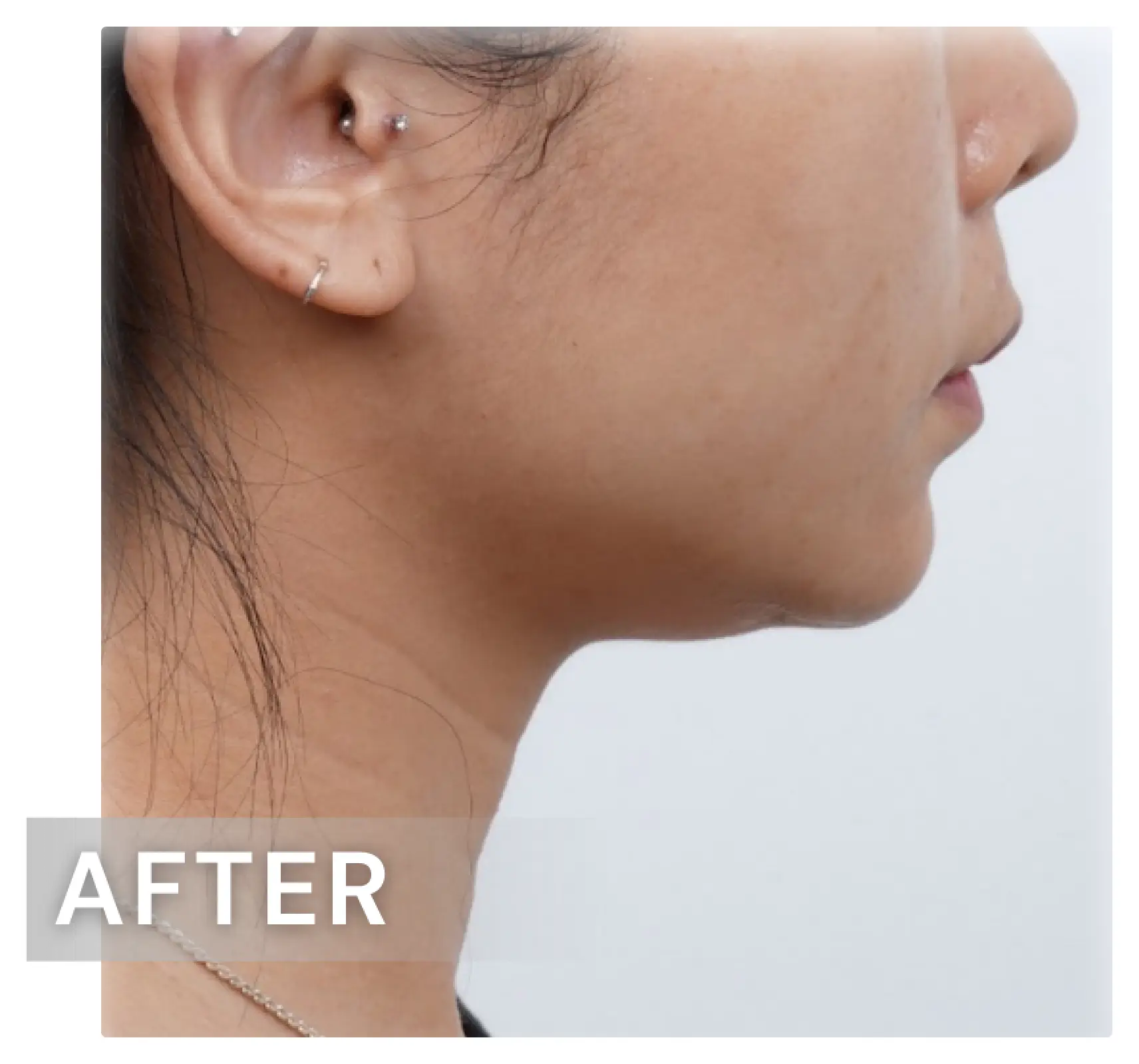 雙下巴療程案例04-after.webp