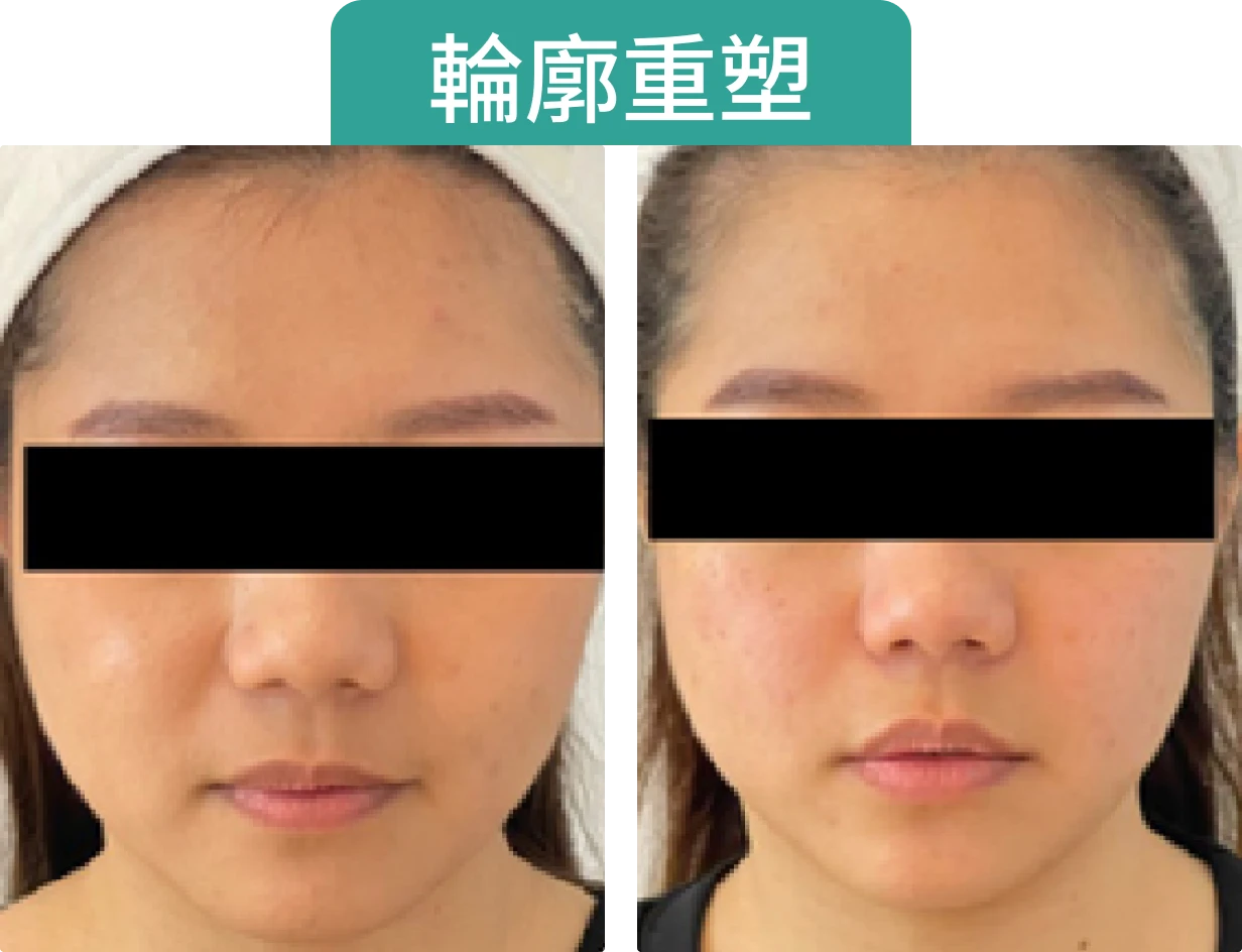 圖片顯示兩幅面部照片，左側為施療前，右側為施療後，顯示改善效果。