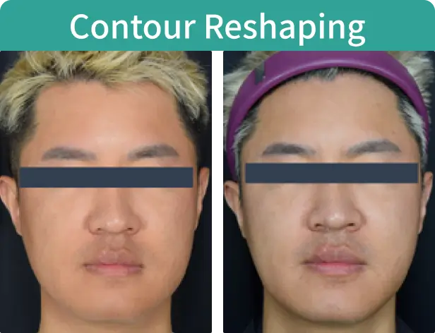 Contour Reshaping-3.webp