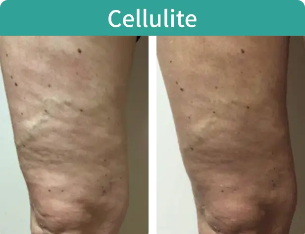 Cellulite-1.webp