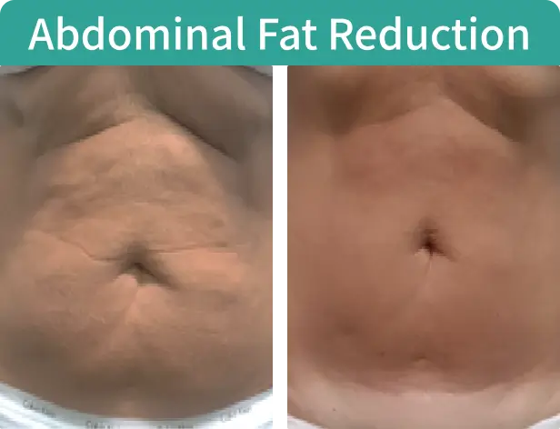Abdominal Fat Reduction-1.webp