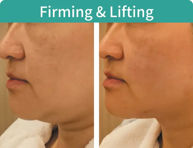 Firming & Lifting-1.webp