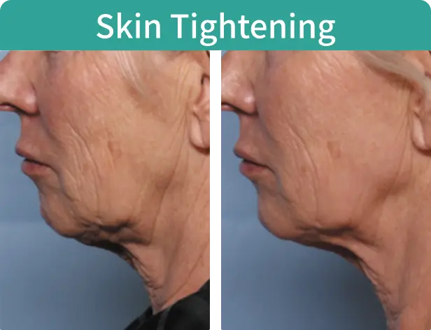 Skin Tightening.webp