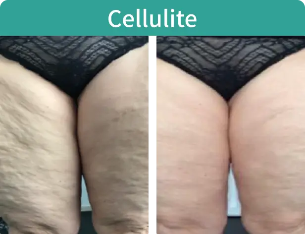 Cellulite-2.webp