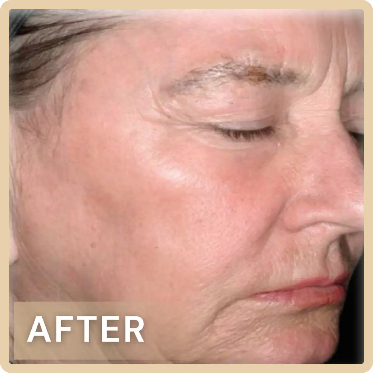 分解黑色素 均勻膚色-after.webp