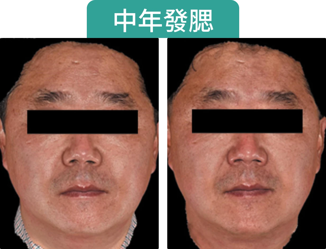 中年男子的面部特寫，左側與右側有所不同，顯示Onda Pro治療後效果，標題為「中年發腮」。
