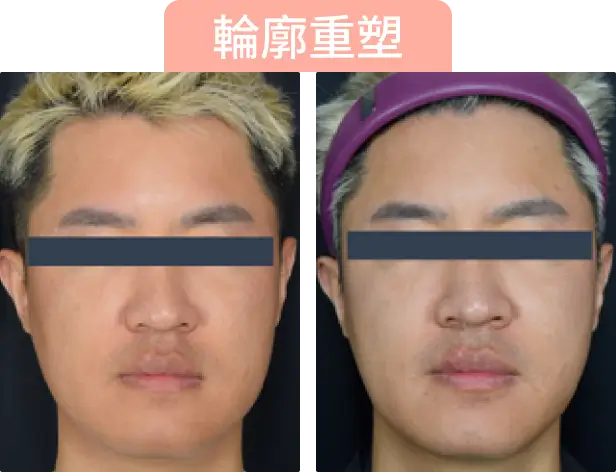 兩張面部照片，顯示不同表情和髮型，其中包含「輪廓重塑」的標題。