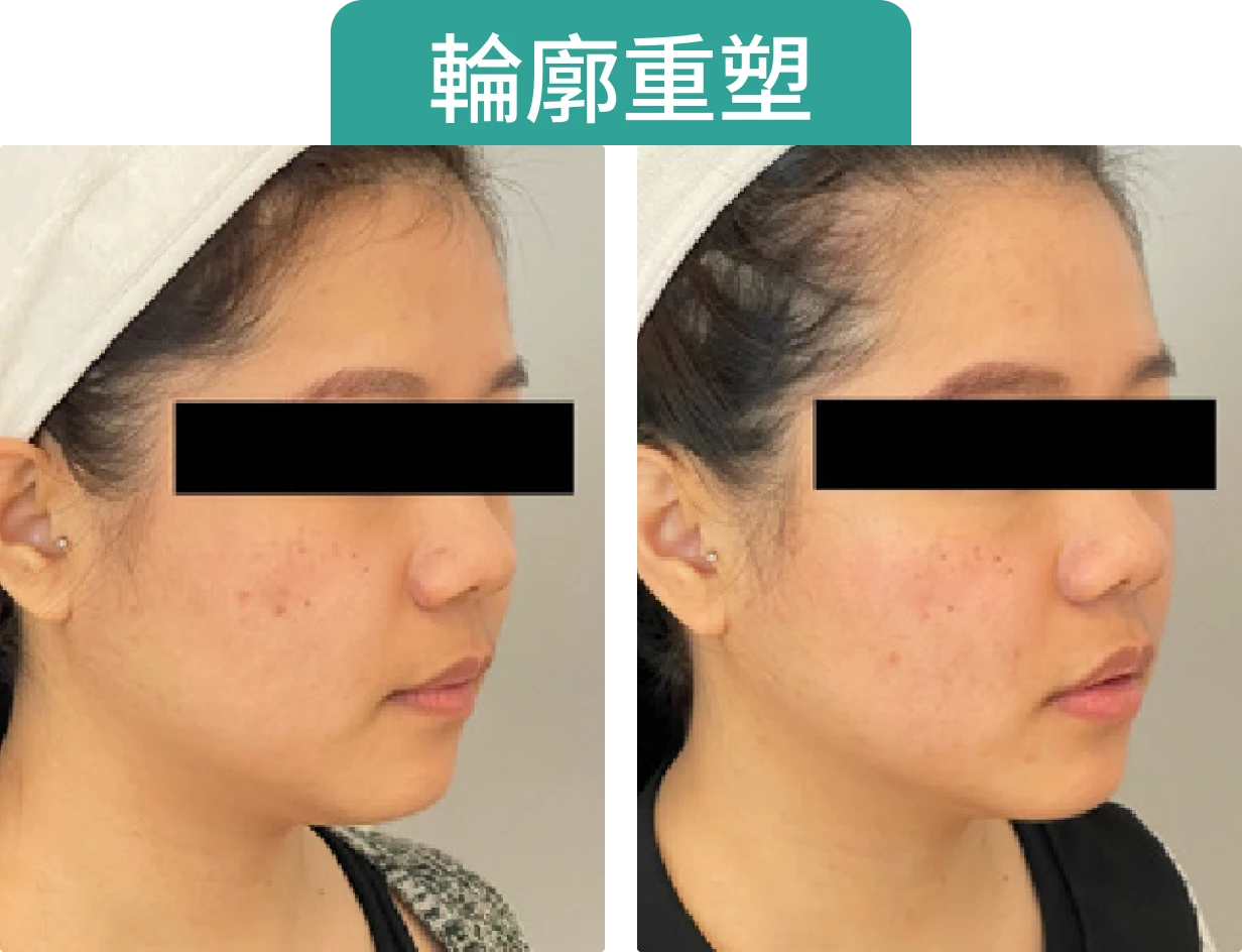 展示同一女性面部側面的對比圖，顯示改善輪廓重塑的變化。