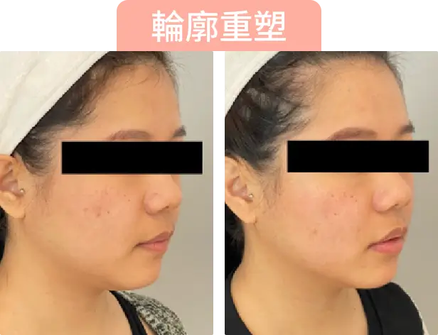 展示同一女性面部側面的對比圖，顯示改善輪廓重塑的變化。