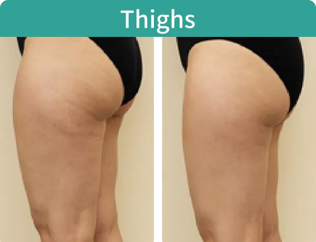 Thighs-1.webp