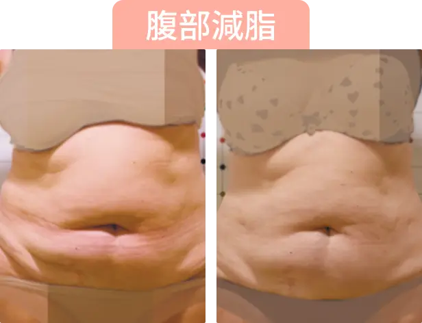 腹部減脂前後對比圖片，顯示減脂後的腹部輪廓變化。