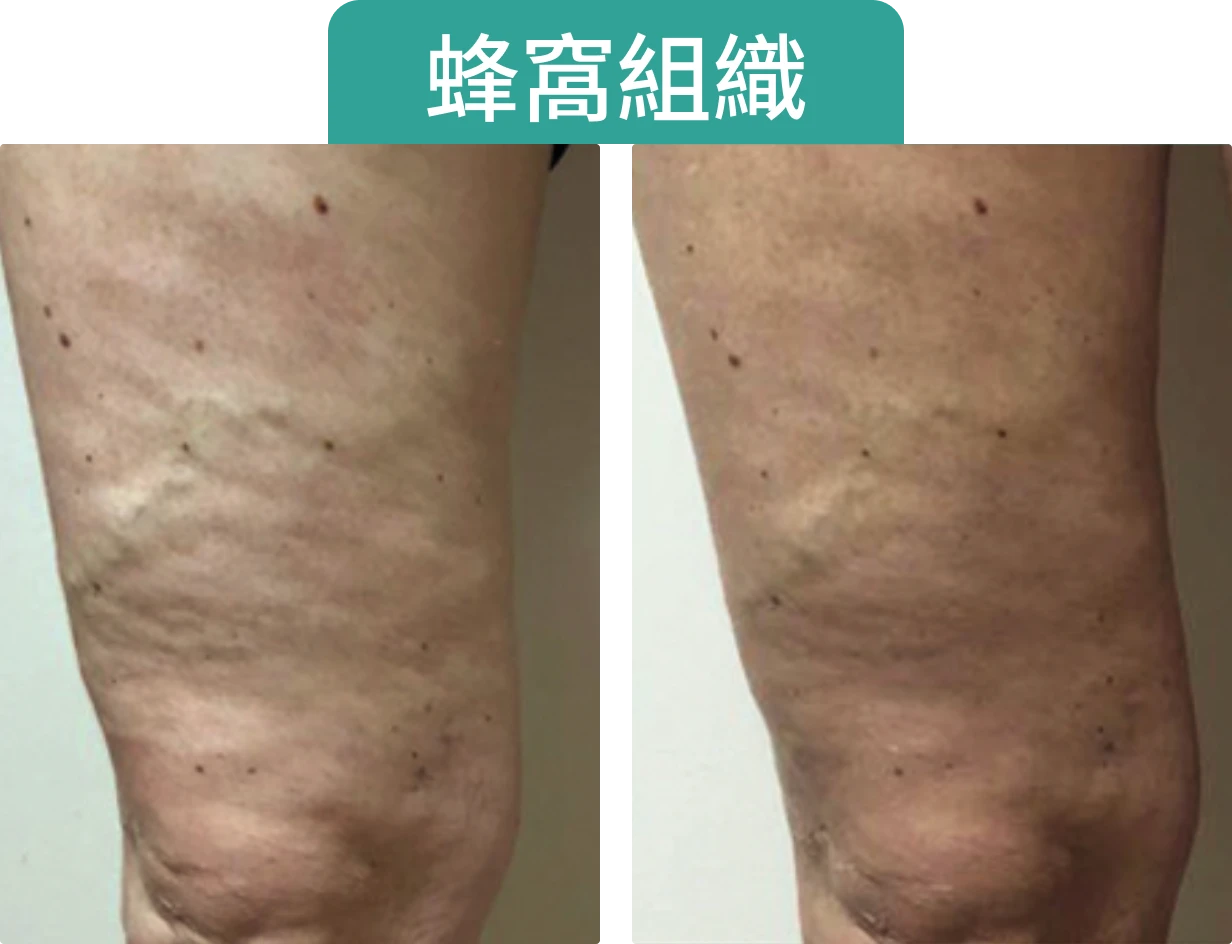 腿部皮膚顯示蜂窩組織的對比，左側和右側的狀態不同。