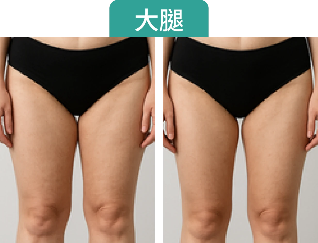 左右兩側腿部的比較圖，大腿明顯在Onda Pro治療後腿部變細。