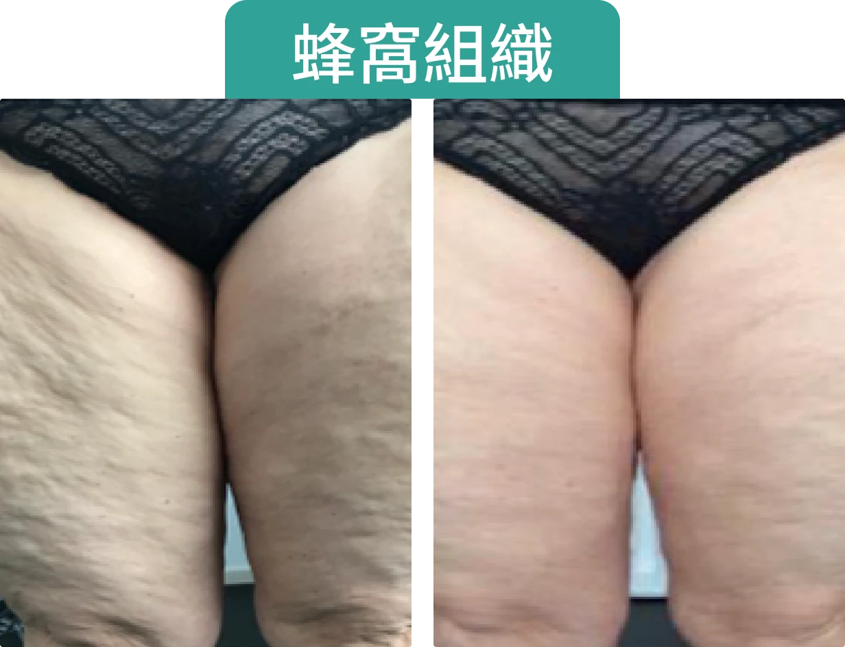 圖片顯示兩條大腿的比較，左側有明顯的妊娠紋，右側較光滑，標題為「蜂窩組織」。