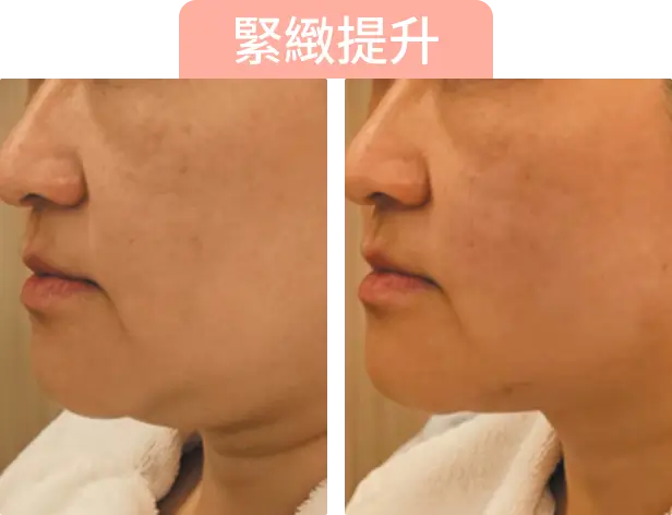 面部輪廓改善前後對比，左側為改善前，右側為改善後，顯示Onda Pro溶脂後肌膚緊緻提升的效果。