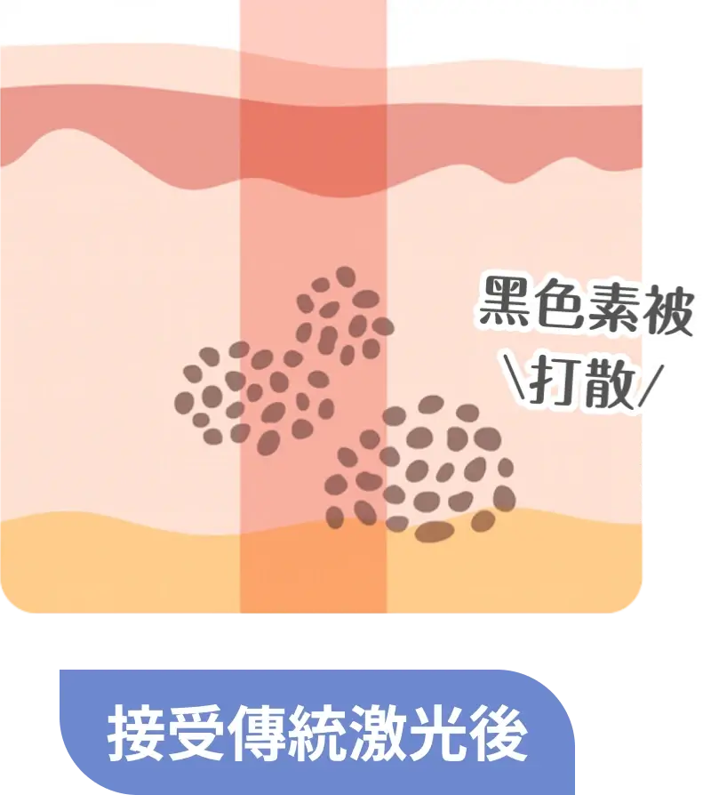 接受傳統激光後：皮膚內黑色素被打散（皮秒對比示意）