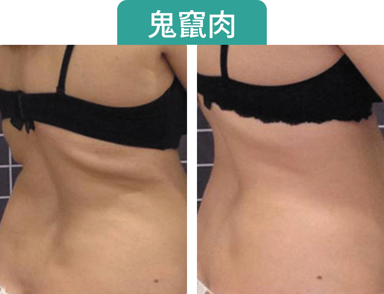 對比兩張女性側身照片，左側顯示較多腹部脂肪，右側則較為纖瘦。上方有“鬼竄肉”字樣。