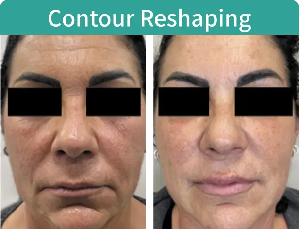 Contour Reshaping-1.webp