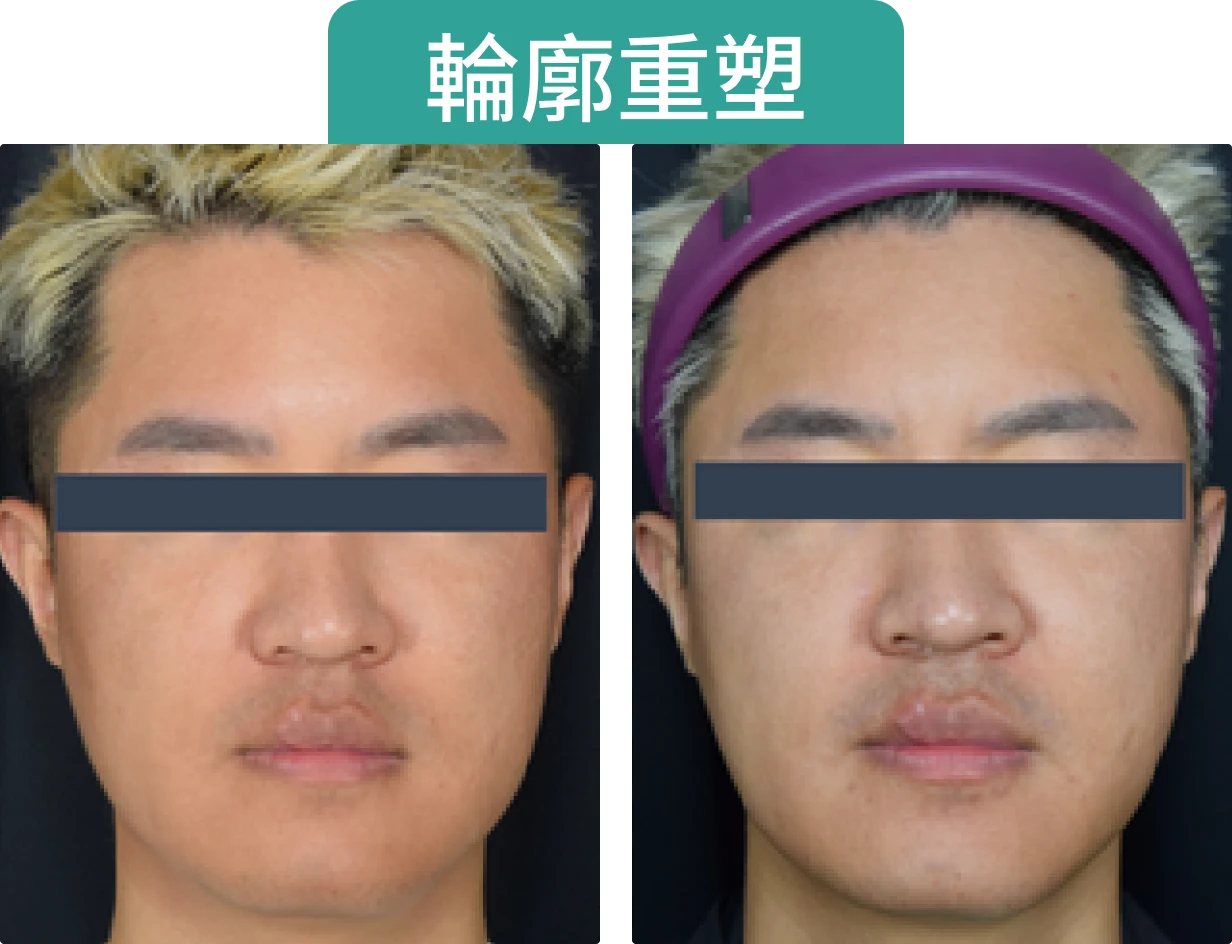 兩張面部照片，顯示不同表情和髮型，其中包含「輪廓重塑」的標題。