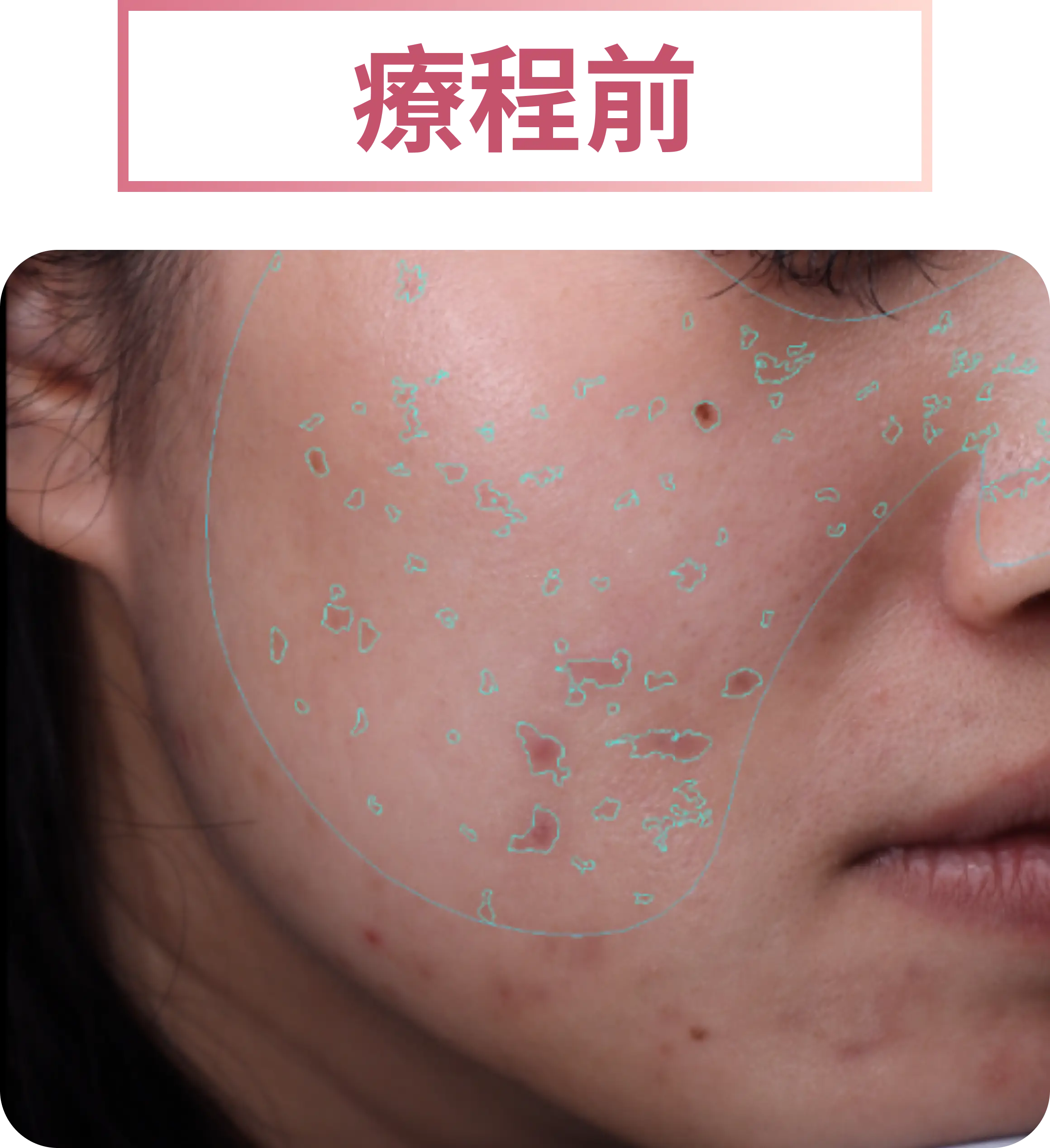 療程前：皮秒治療前右頰色斑以青色輪廓標示
