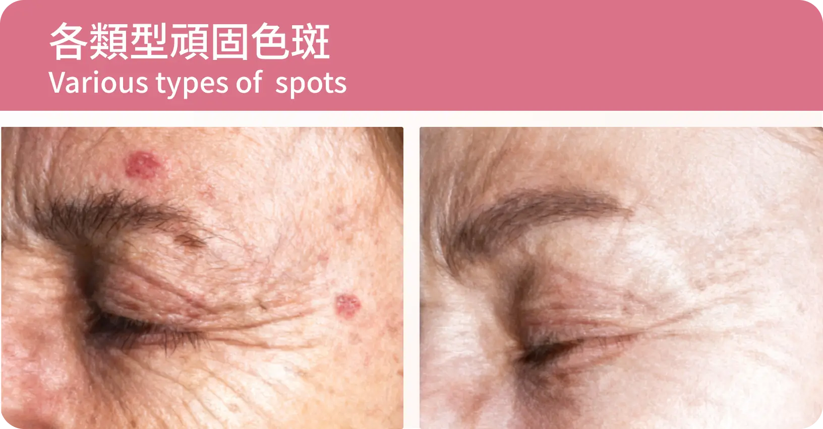 各類型頑固色斑：眼側多種斑點皮秒治療前後對比