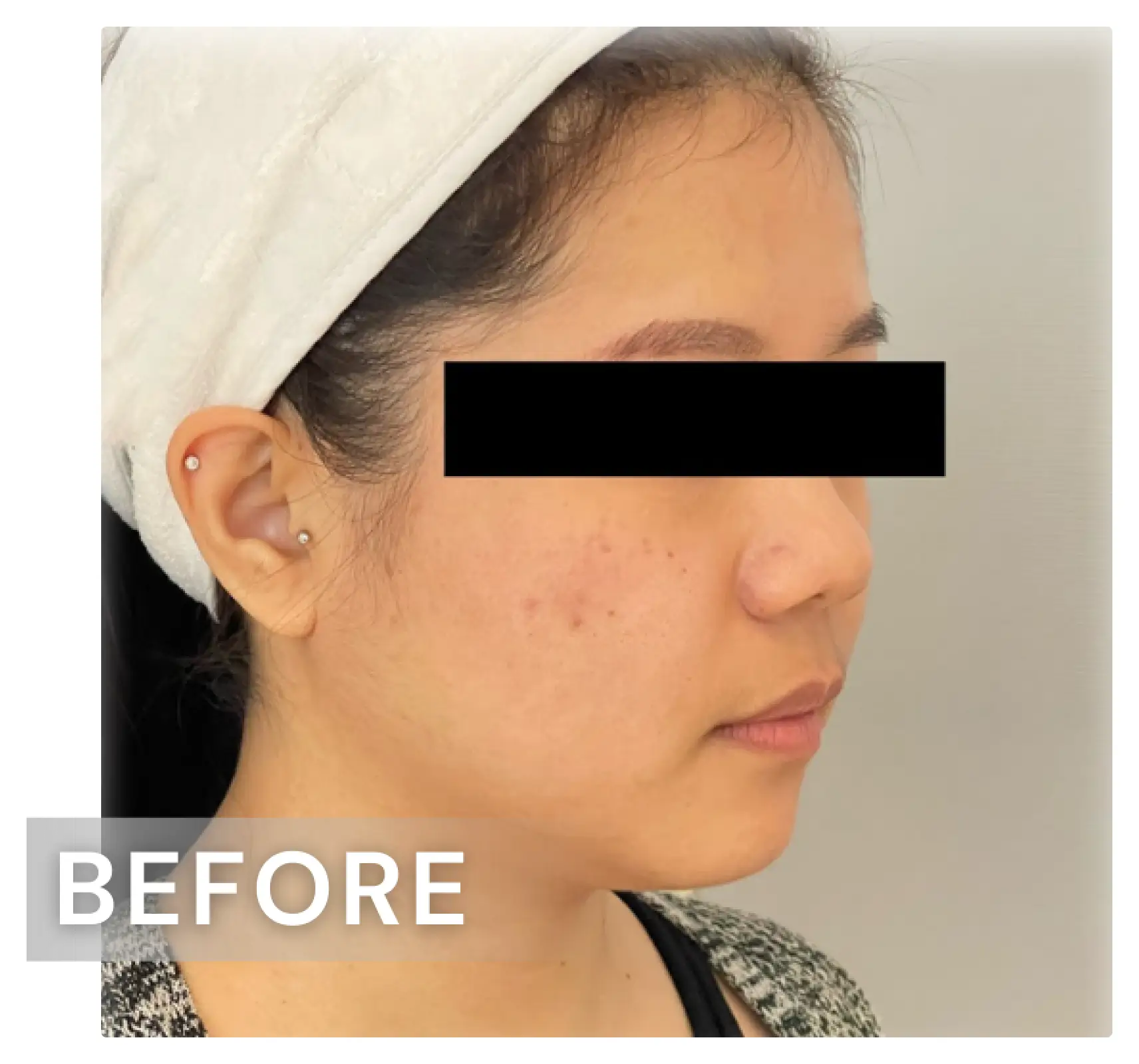 雙下巴療程案例01-before.webp