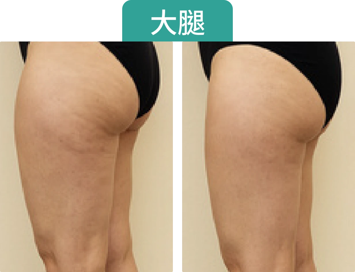 圖片展示了兩條大腿的側面，左側有條紋，右側較為平滑。上方有「大腿」字樣。