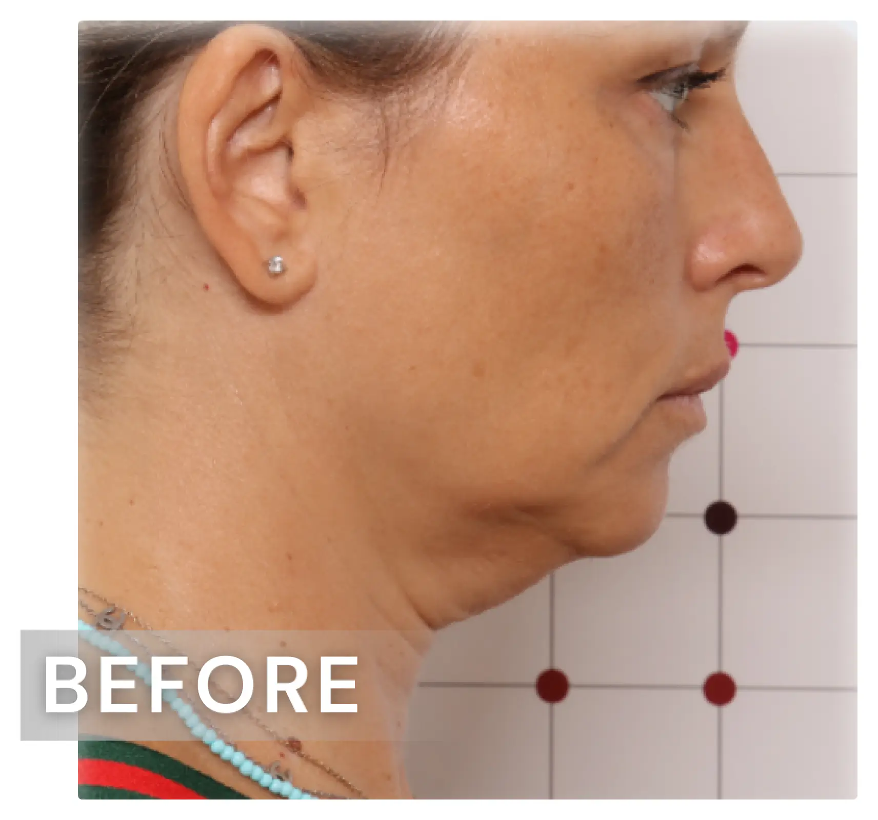 雙下巴療程案例04-before.webp