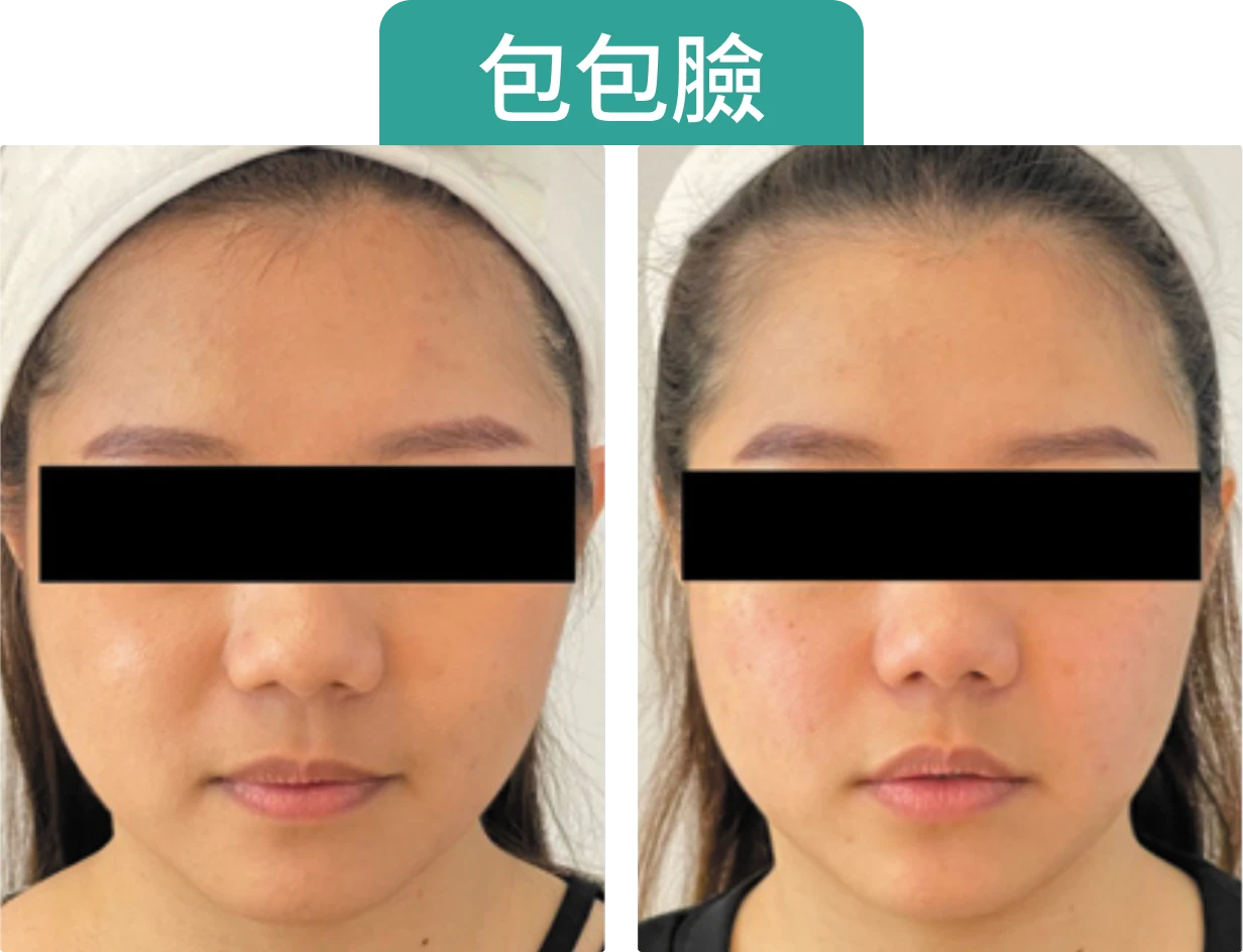 兩張女性面部照片的對比，顯示Onda Pro治療後效果。上方有「包包臉」的字樣。