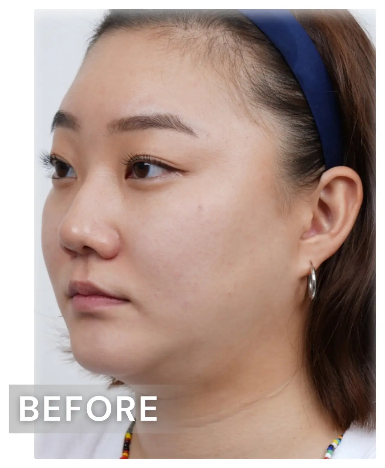 面部提升-before.webp