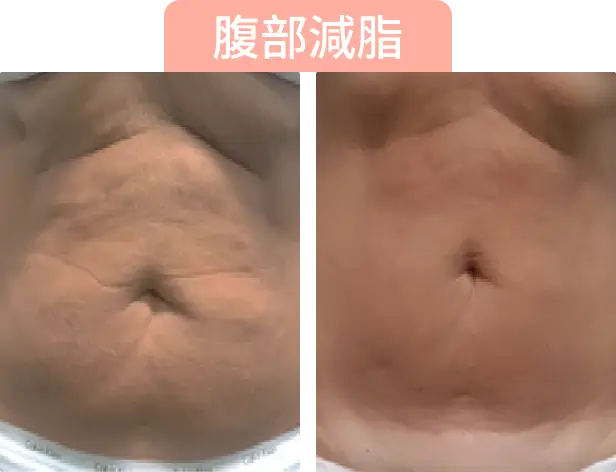 腹部減脂前後的對比圖，顯示減少的脂肪及腹部的變化。