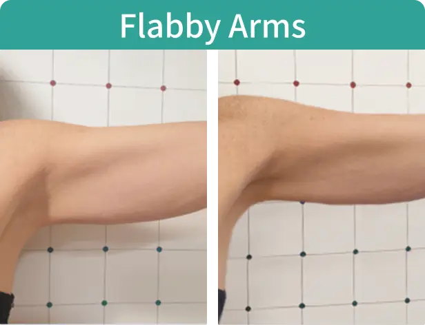 Flabby Arms.webp