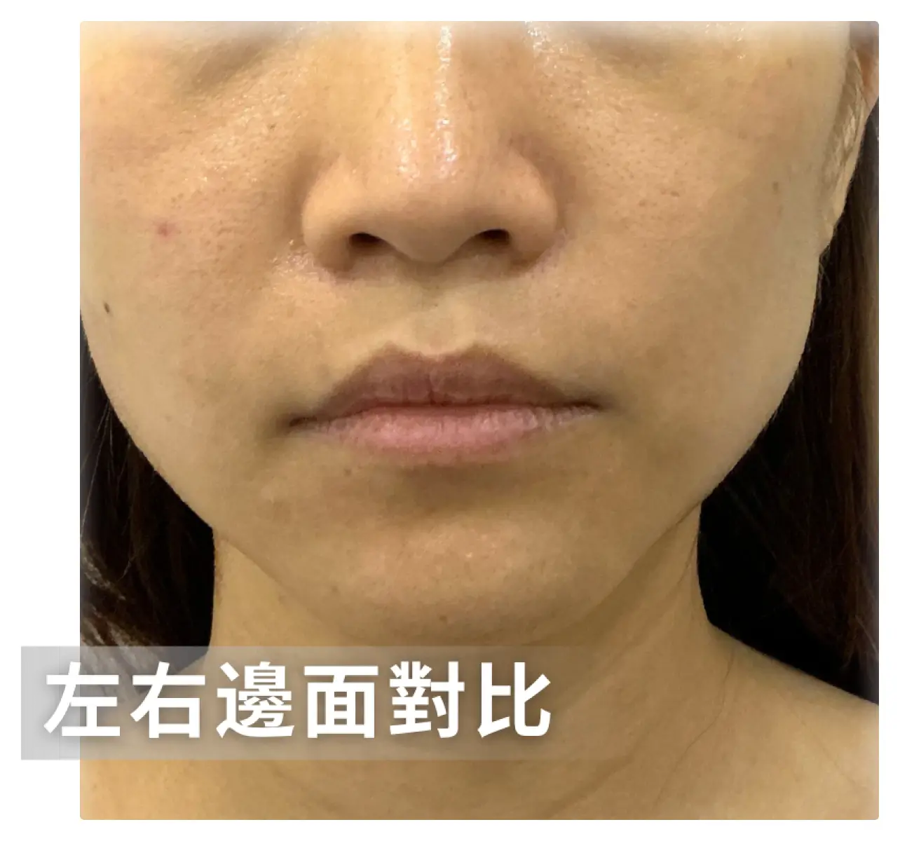 虎紋下顎線-左右邊面對��比.webp