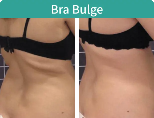 Bra Bulge.webp