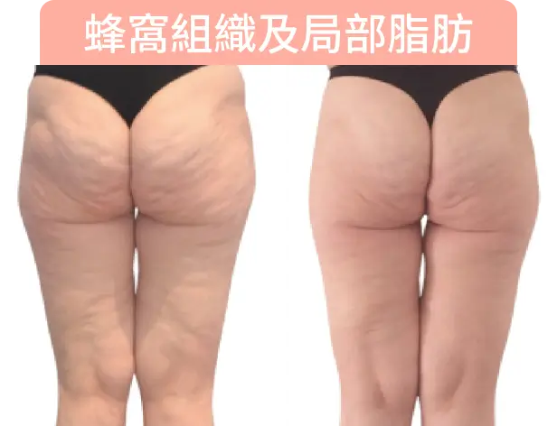 展示兩個人的臀部，左側有明顯的脂肪和紋路，右側則較為平滑。