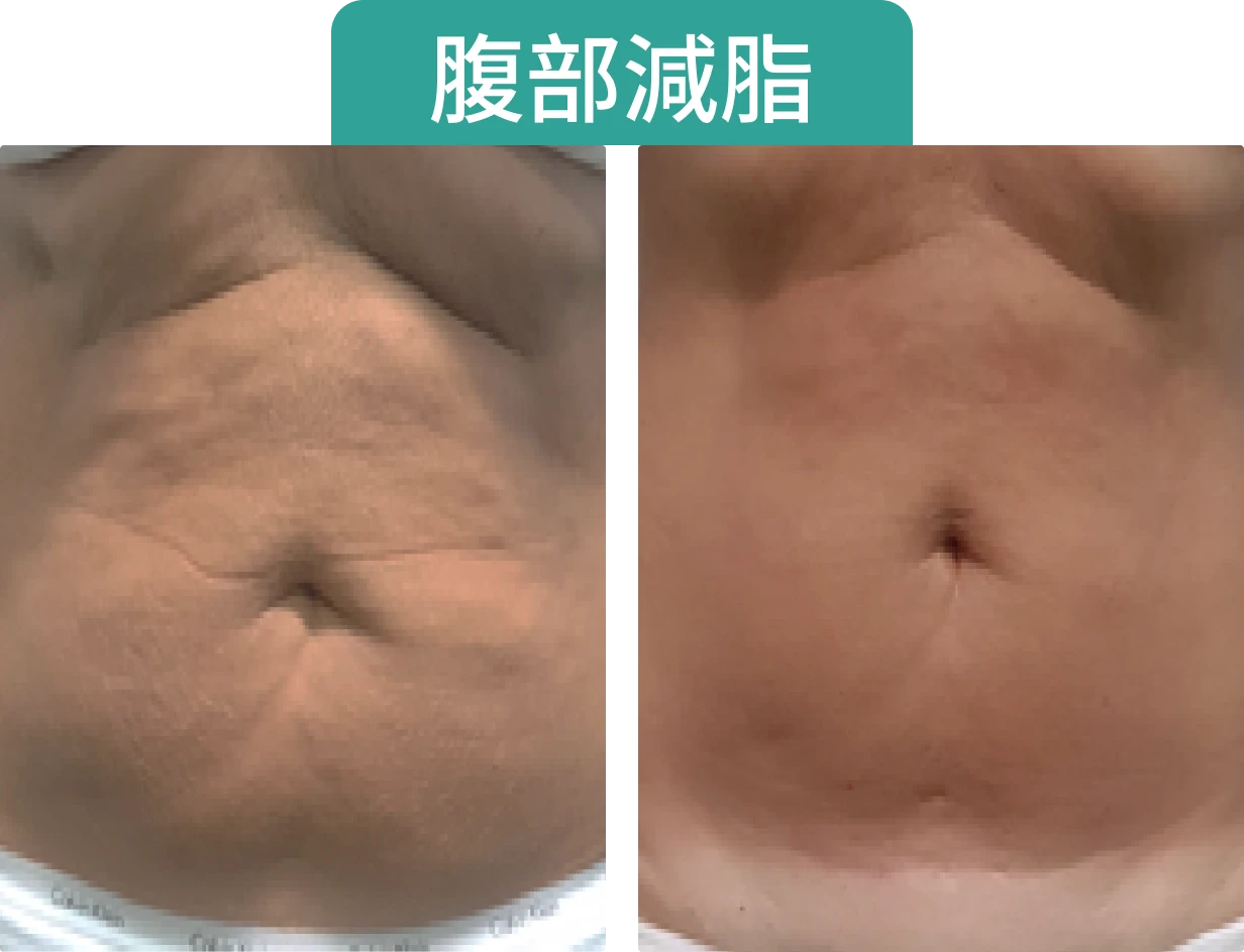 腹部減脂前後的對比圖，顯示減少的脂肪及腹部的變化。