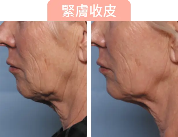 左右對比兩張面部側影，左側顯示皮膚鬆弛，右側顯示緊緻效果，顯示Onda Pro 溶脂後的改善效果。上方有「緊膚收皮」文字。